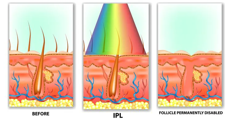 ipl-before_after