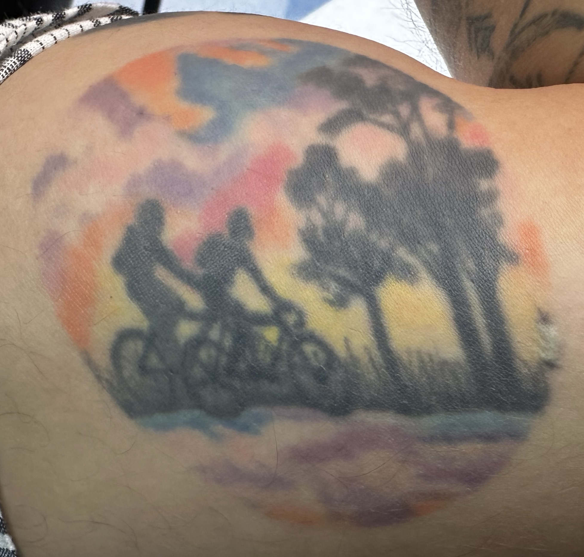 FracTatt tattoo removal