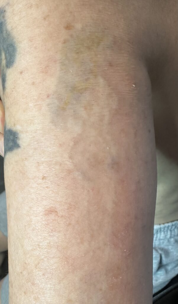 Pico laser scars and ink residue