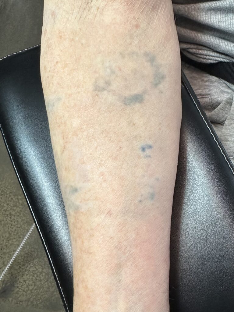 Pico laser scars and ink residue