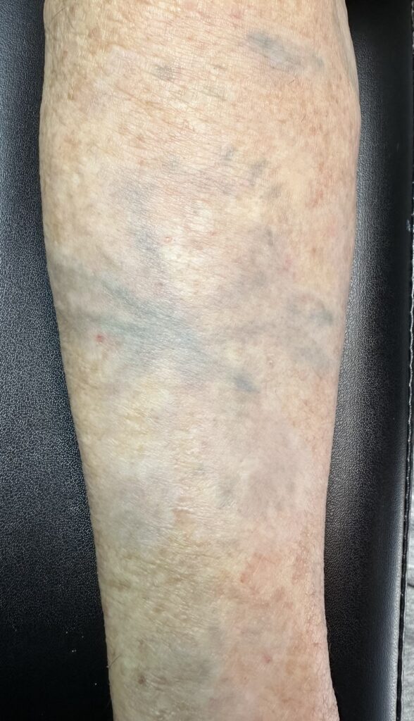 Pico laser scars and ink residue